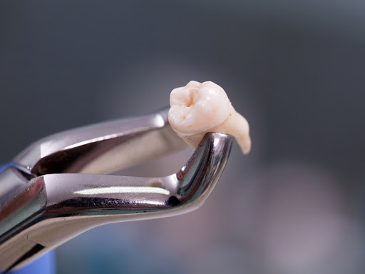 Vì sao trước khi nhổ răng khôn cần xét nghiệm máu? Những lưu ý khi nhổ răng khôn